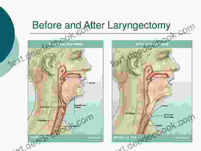 Itzhak Brook Smiling And Speaking With A Tracheoesophageal Voice Prosthesis The Laryngectomee Guide Itzhak Brook M D